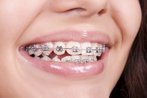 orthodonticsB22208DD-7BFB-74E1-0B78-C227775F4807.jpg